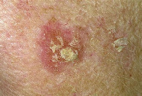 Actinic keratosis - Pictures, Causes, Symptoms and Treatment