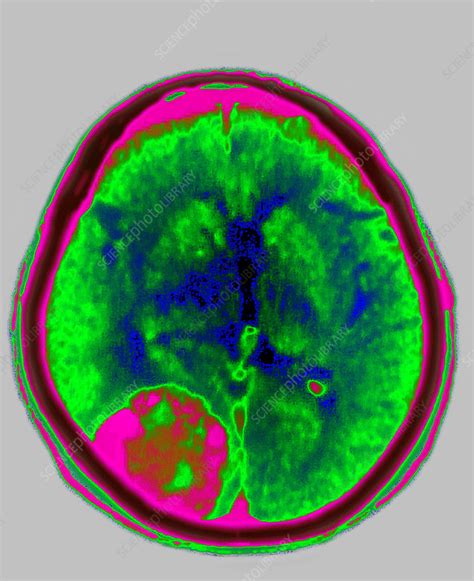 Meningioma Ct Scan - Stock Image - C017/0054 - Science Photo Library