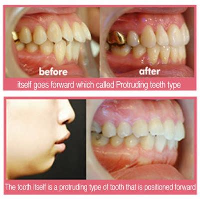 What is Faceline’s ASO (protruding mouth) Surgery?