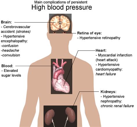 Complications of hypertension