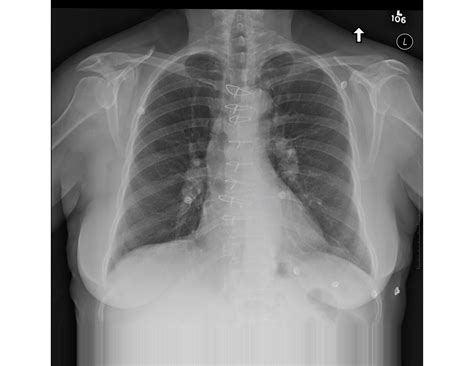 Chest x-ray of patient with suspected pulmonary embolism (PE)