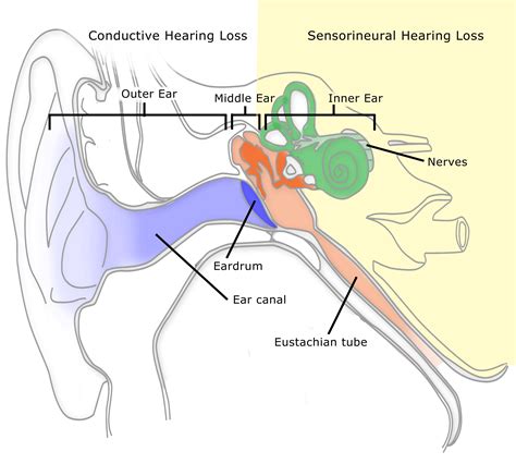 Hearing Loss - Fix Your Ears