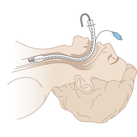 Endotracheal Tube Holder