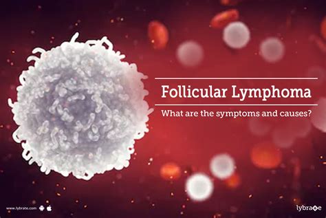 Follicular Lymphoma - What are the symptoms and causes? - By Dr. Garima ...