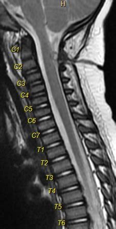 Cervical Dermal Sinus Associated With Intradural Dermoid Cyst ...