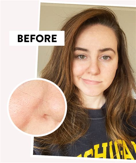 I Tried a Pore Vacuum—Here's What Happened | The Everygirl