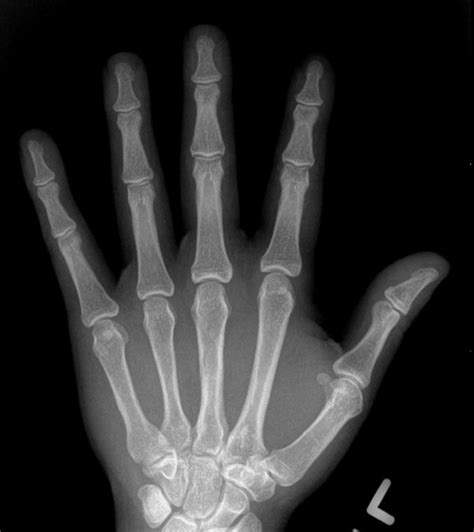 hand arthritis on x-rays | Raleigh Hand to Shoulder Center