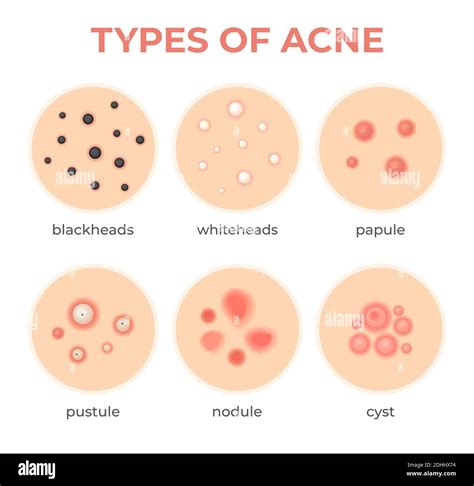 Types d'acné. Problème d'infection de la peau, boutons grade et type ...