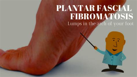 Plantar Fascial Fibromatosis- Cause, Symptoms & Treatment