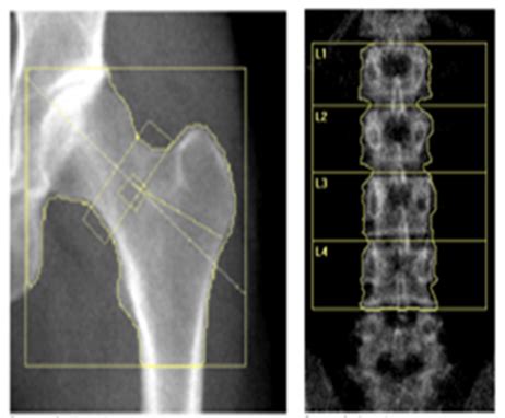 Hormone treatment restores bone density for young women with menopause-like condition | National ...