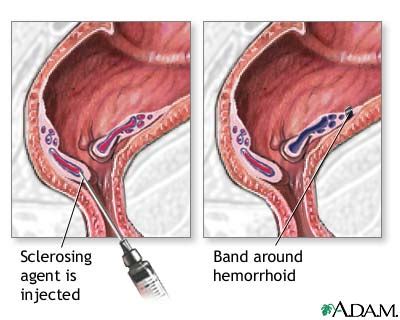 Hemorrhoid surgery - series—Procedure: MedlinePlus Medical Encyclopedia