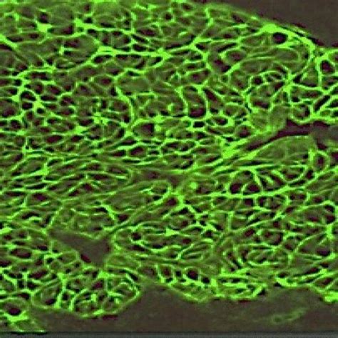 Photomicrograph showing an intense positivity for anti-endomysial ...