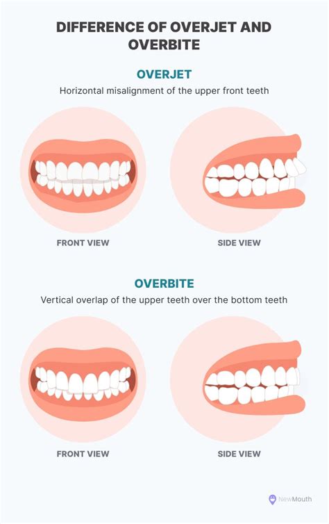 Overbite vs Overjet: Understanding the Differences