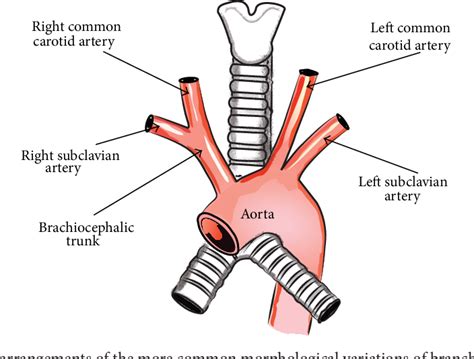 Figure 1 from The Aberrant Right Subclavian Artery (Arteria Lusoria ...