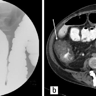 a) Apple core lesion in the ascending colon in double contrast colonic... | Download Scientific ...