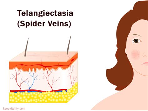 Spider Veins: Symptoms, Causes and Treatment - Keep Vitality