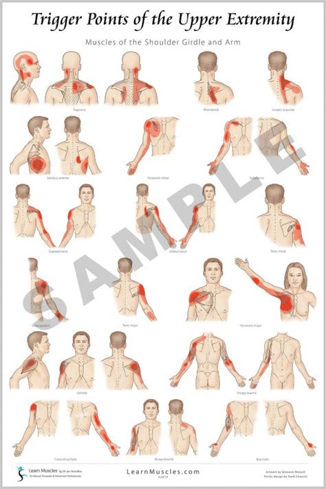 Trigger Point - Upper Extremity 24" x 36" Premium Poster 2 Pack - Learn Muscles