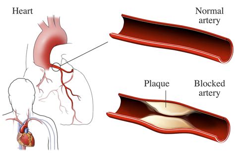 Ischemic Heart Disease | National Heart, Lung, and Blood Institute (NHLBI)