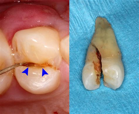 First bite syndrome causes - tattoopoliz