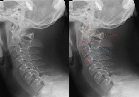 Hangman's Fracture - Physiopedia