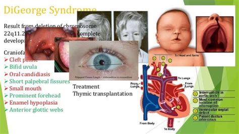 Pin by Miroslawa Bodnar on PA | Digeorge syndrome, Medical problems