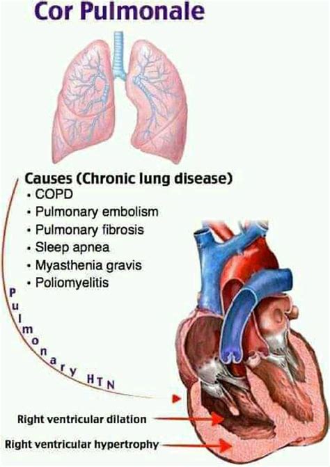 #Cor_pulmonale ⬅ is defined as an alteration in the - MEDizzy