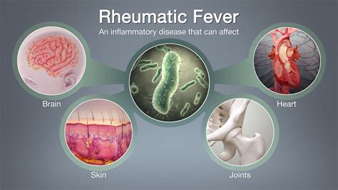 Rheumatic Fever: Symptoms, Causes, and Treatment - Scientific Animations