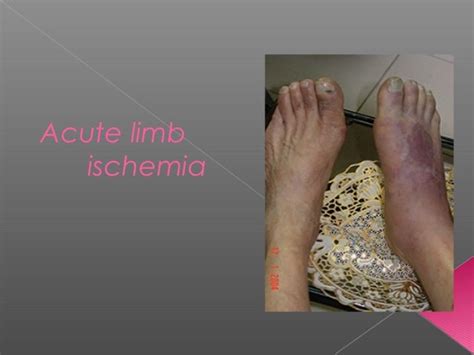 Acute Limb Ischemia Pathophysiology