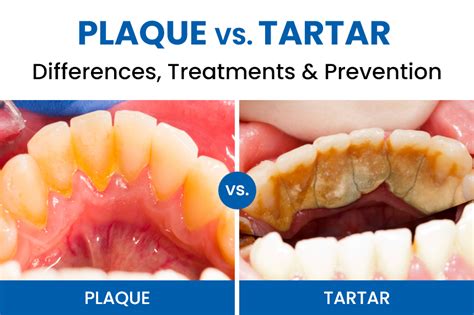 Plaque vs. Tartar: Differences, Treatments & Prevention