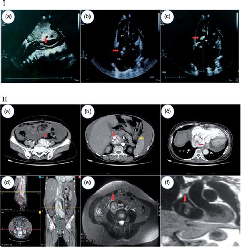 Figure 1 from Surgical treatment of intravenous leiomyomatosis ...