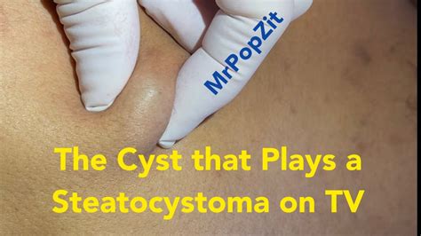 The cyst that plays a Steatocystoma on TV. Juicy cyst pop and removal on patient with ...