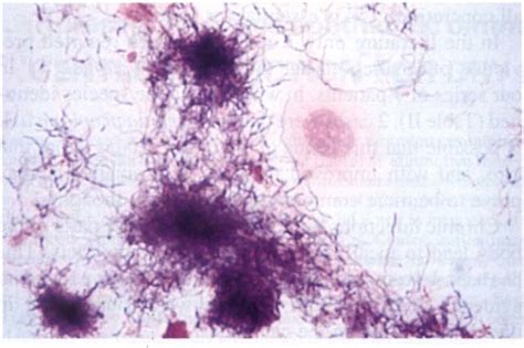 Actinomyces Israelii Gram Stain