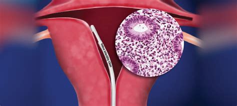 Endometrial Biopsy