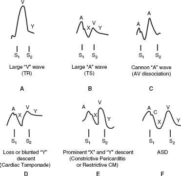 A Wave V Wave Cardiology - Shajara