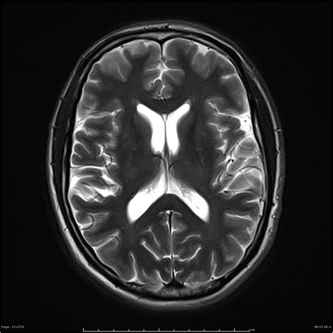 Cavum septum pellucidum | Image | Radiopaedia.org