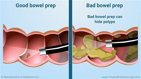 What is a colonoscopy and how do I prepare for it? | Colonoscopy ...