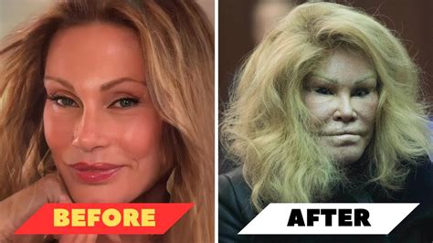 Celebrity Plastic Surgery Before And After Gone Wrong - Infoupdate.org