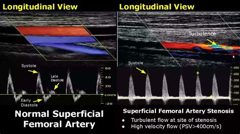 Femoral Artery Doppler Ultrasound Normal Vs Abnormal | Stenosis/Occlusion/Pseudoaneurysm/AVF USG ...