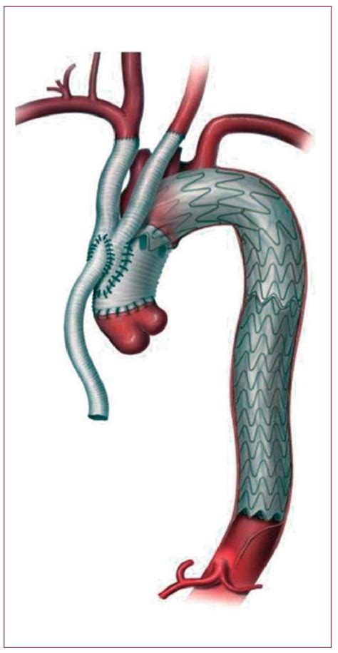 Aortic Dissection Stent