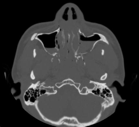 LeFort fracture - wikidoc