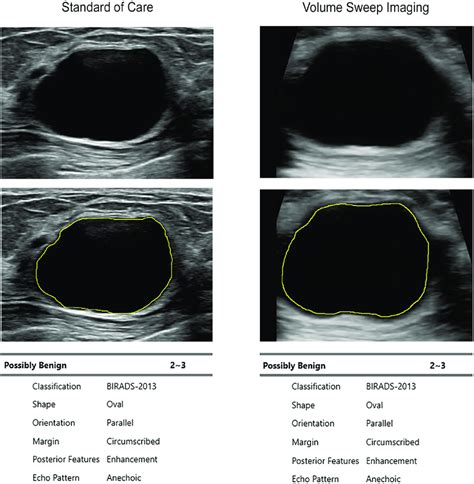 S-Detect Interpretation of a Cyst on Standard of Care and VSI. B-mode... | Download Scientific ...