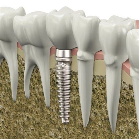 Why is titanium used for tooth implants? - Wisdom Teeth & Dental Implants | Colleyville Oral Surgeon