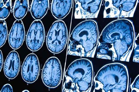 Tumor cerebral: qué es, síntomas y tratamiento