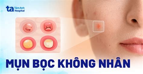 Mụn bọc không đầu (nhân): Nguyên nhân, triệu chứng, điều trị