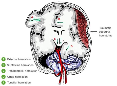 Brain Herniation Types