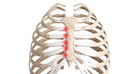 Costochondral Separation - Symptoms, Causes, Treatment & Exercises