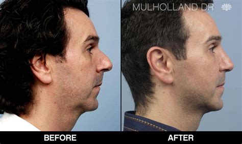 Male Rhinoplasty Before & After Photo Gallery | TPS