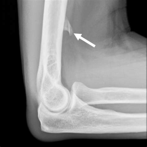 Pitfalls in Elbow Imaging: Osseous Anatomic Variants - ARRS InPractice