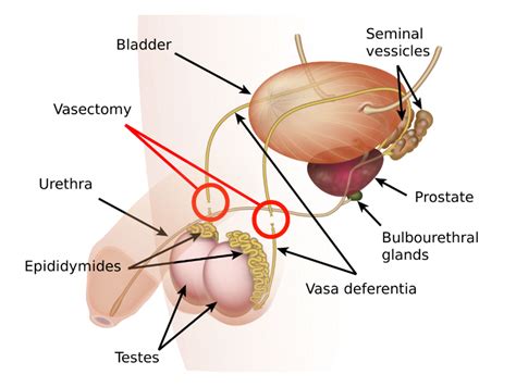 Non-Scalpel Vasectomy Bundaberg - Bundaberg Health Promotions