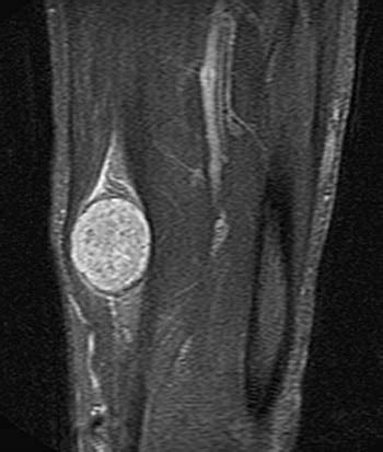 Schwannoma of the Median Nerve | Radsource